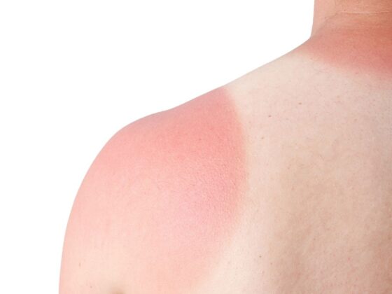 After Sun Care Tips: 6 Expert‑Approved Ways to Soothe & Repair Sun‑Kissed Skin