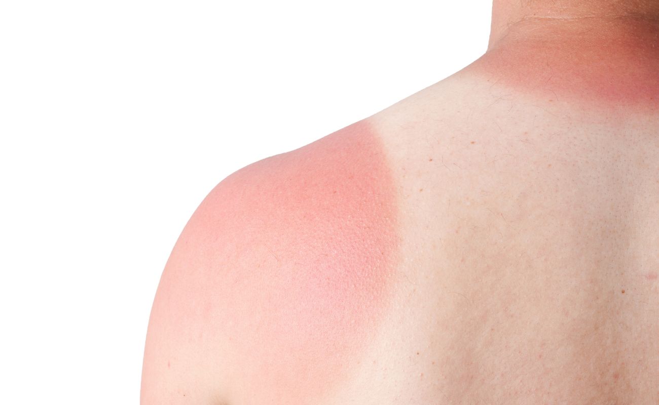 After Sun Care Tips: 6 Expert‑Approved Ways to Soothe & Repair Sun‑Kissed Skin